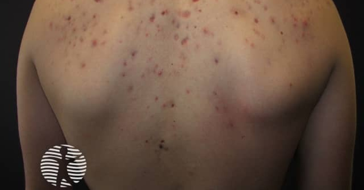 Acne affecting the back images image