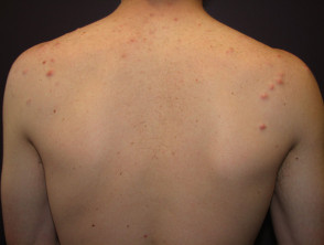 Back Acne ('Bacne') 101: Types, Prevention, and Treatment