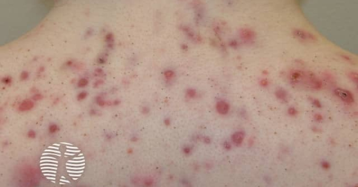 Acne affecting the back images image
