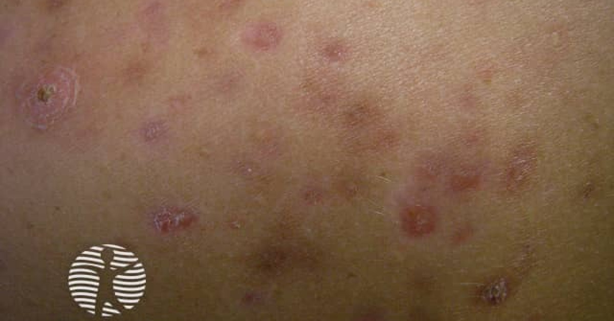 Acne affecting the back images image