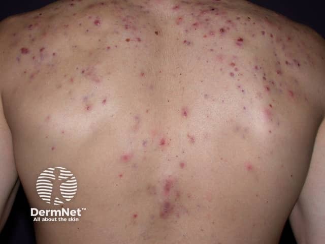 Moderate acne on the back