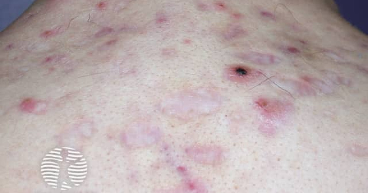 Acneiform Rash Back Acne affecting the back images image