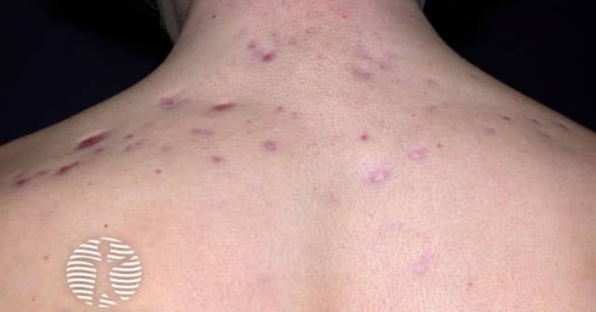 Acne affecting the back images image