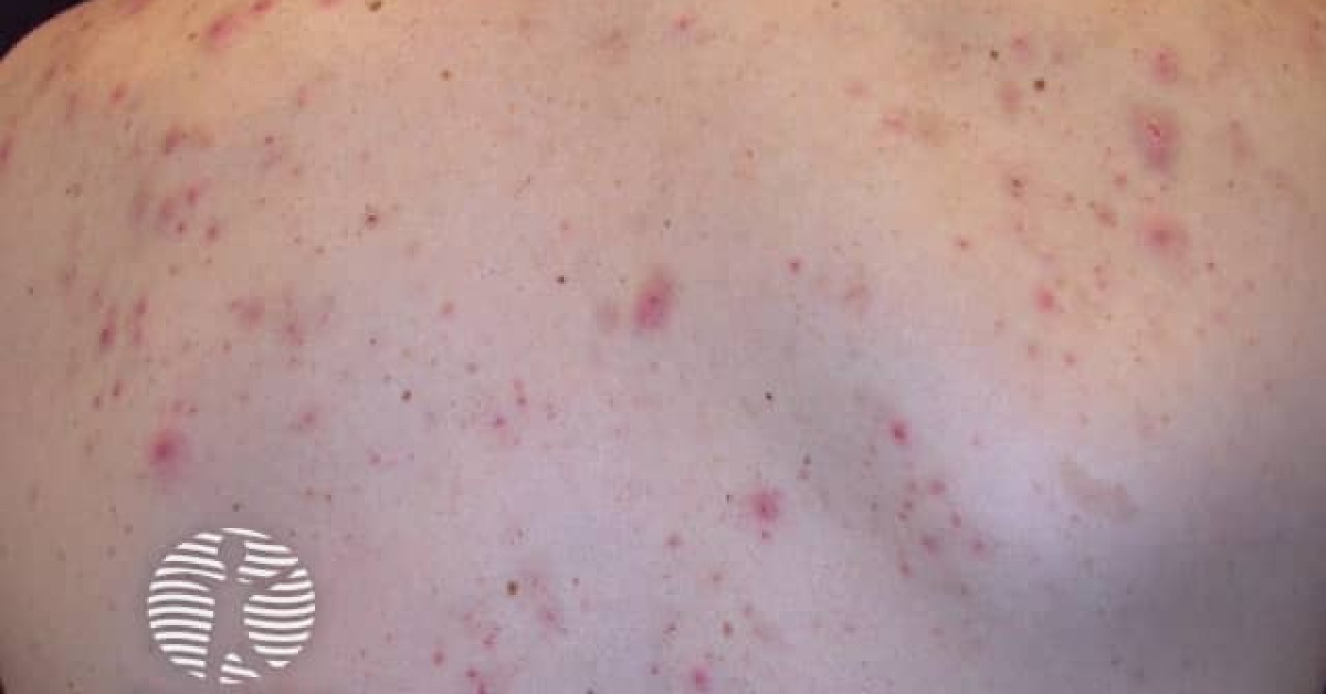 Acne affecting the back images image