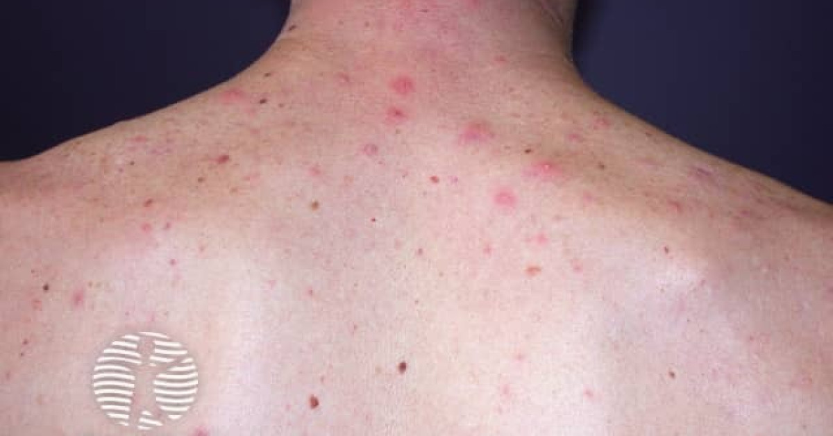 Acne affecting the back images image