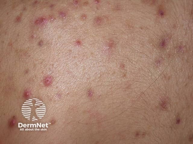 Close-up of papules and pustules in back acne