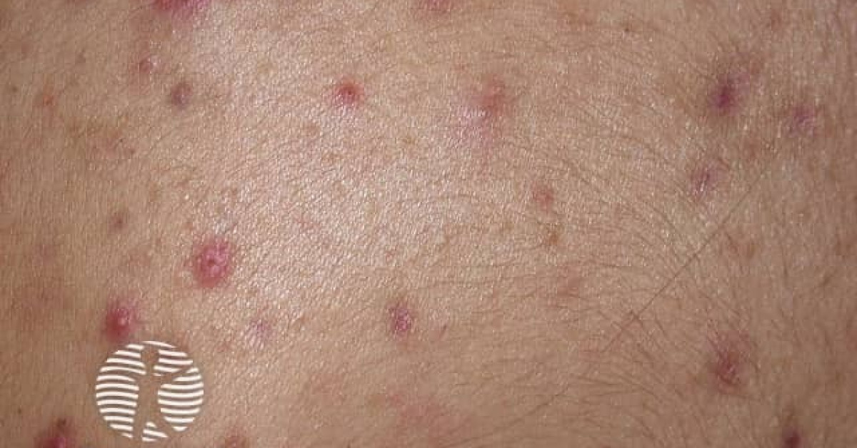 View of Acne affecting the back images image