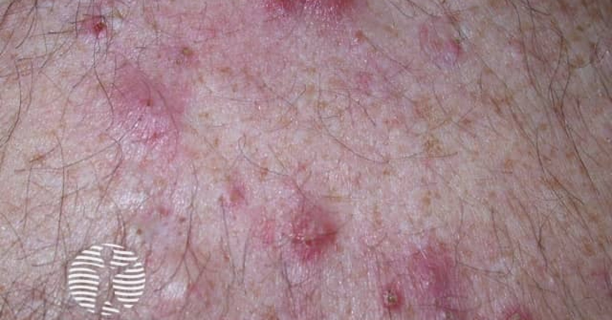 DermNet® - Acne affecting the back images image