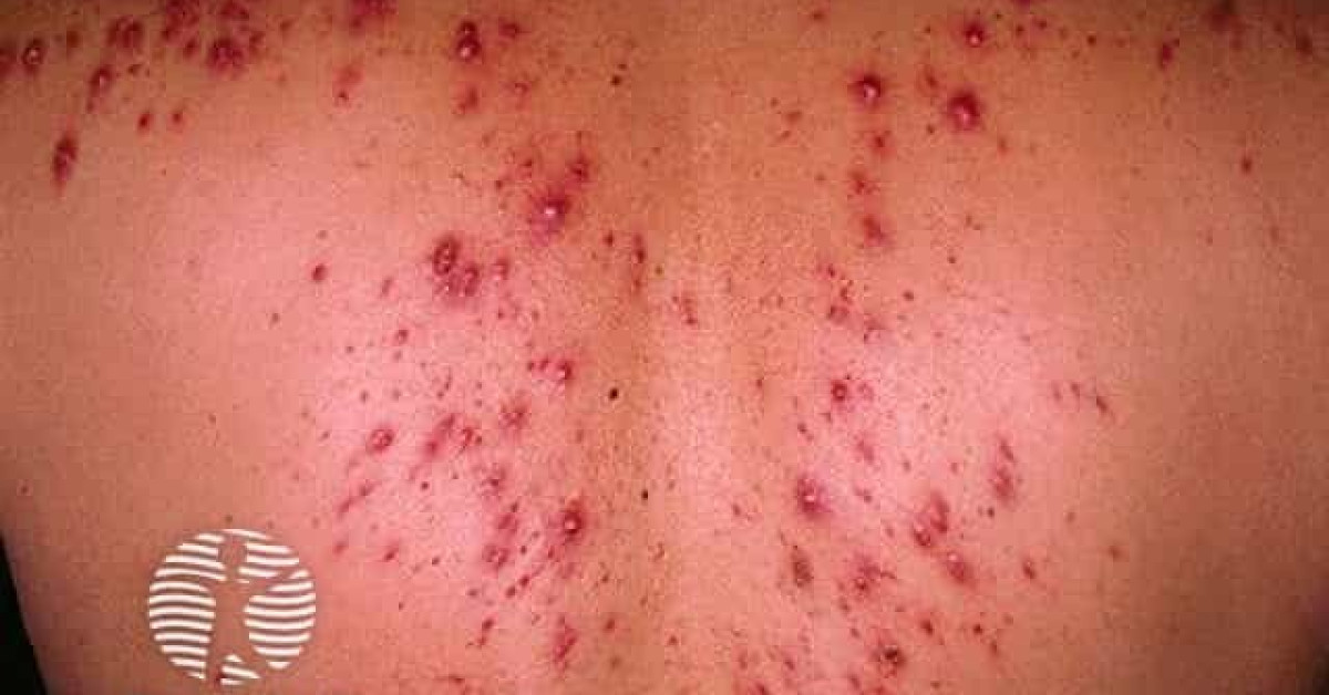 Acneiform Rash Back Acne affecting the back images image