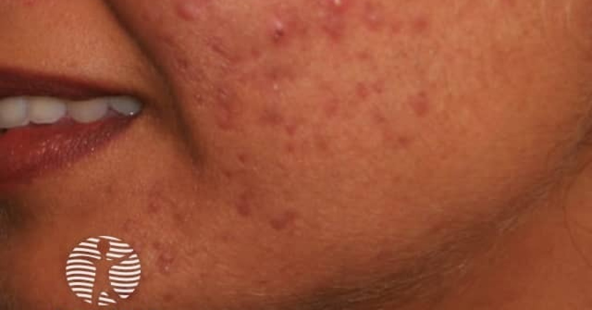 Facial acne image