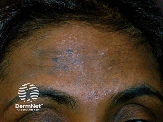 Hyperpigmentation due to acne