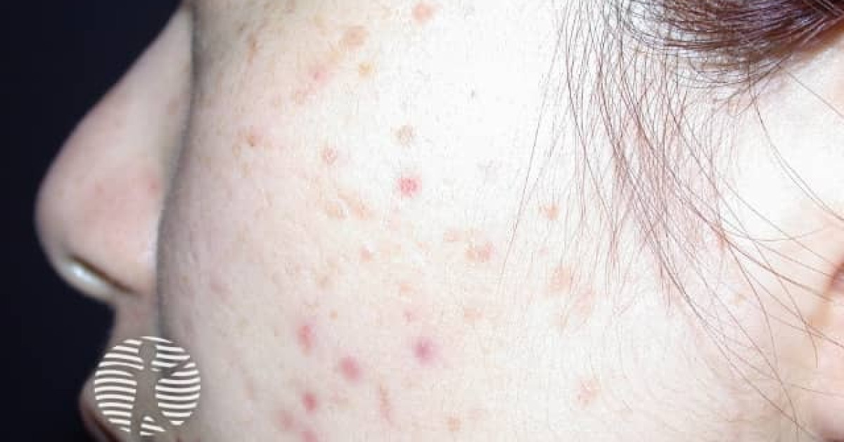 Facial acne image