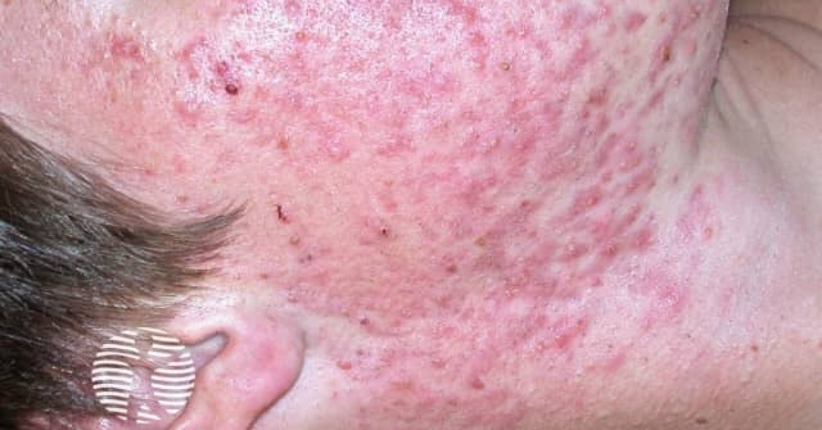 DermNet® - acne-face_16_1 image