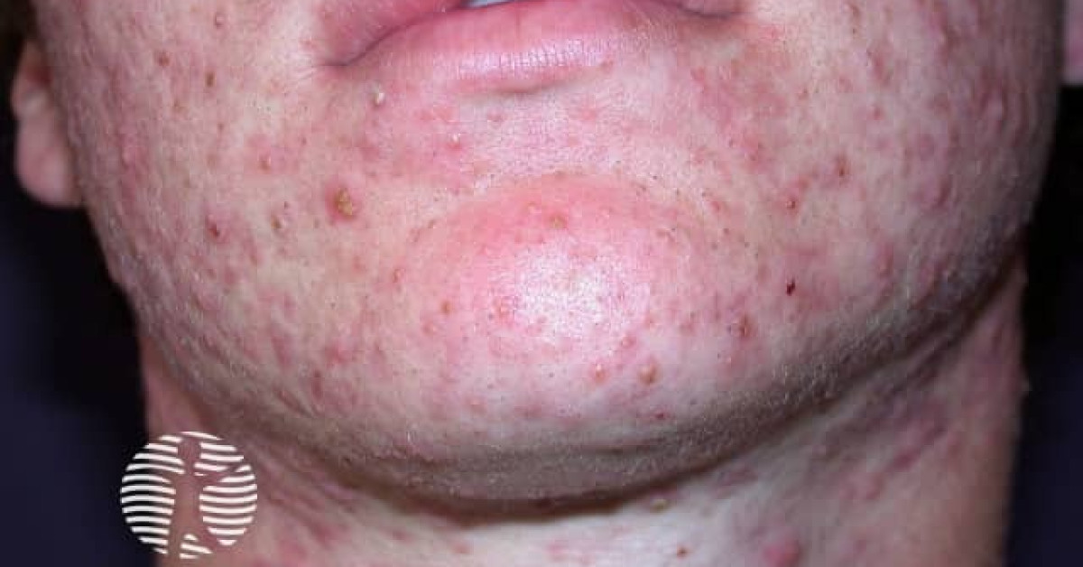 DermNet® - acne-face_19_1 image