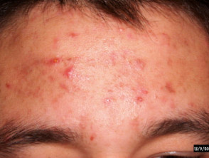 acne-face_19