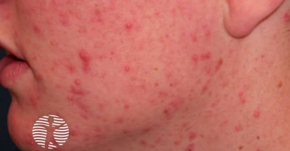 Facial acne image