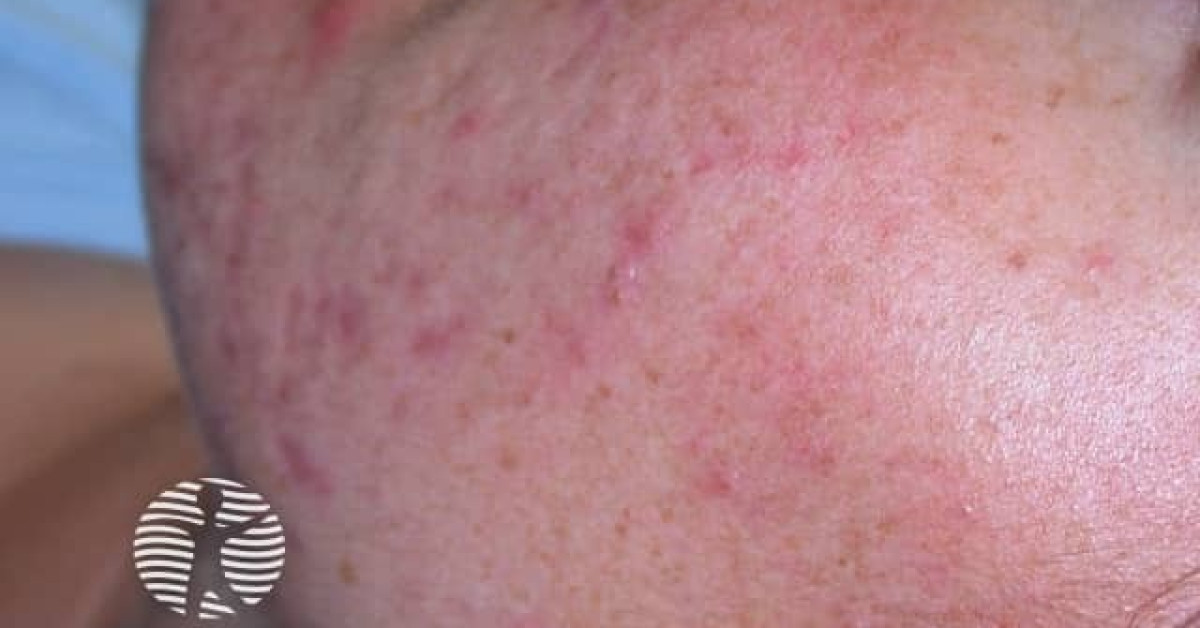 Facial acne image