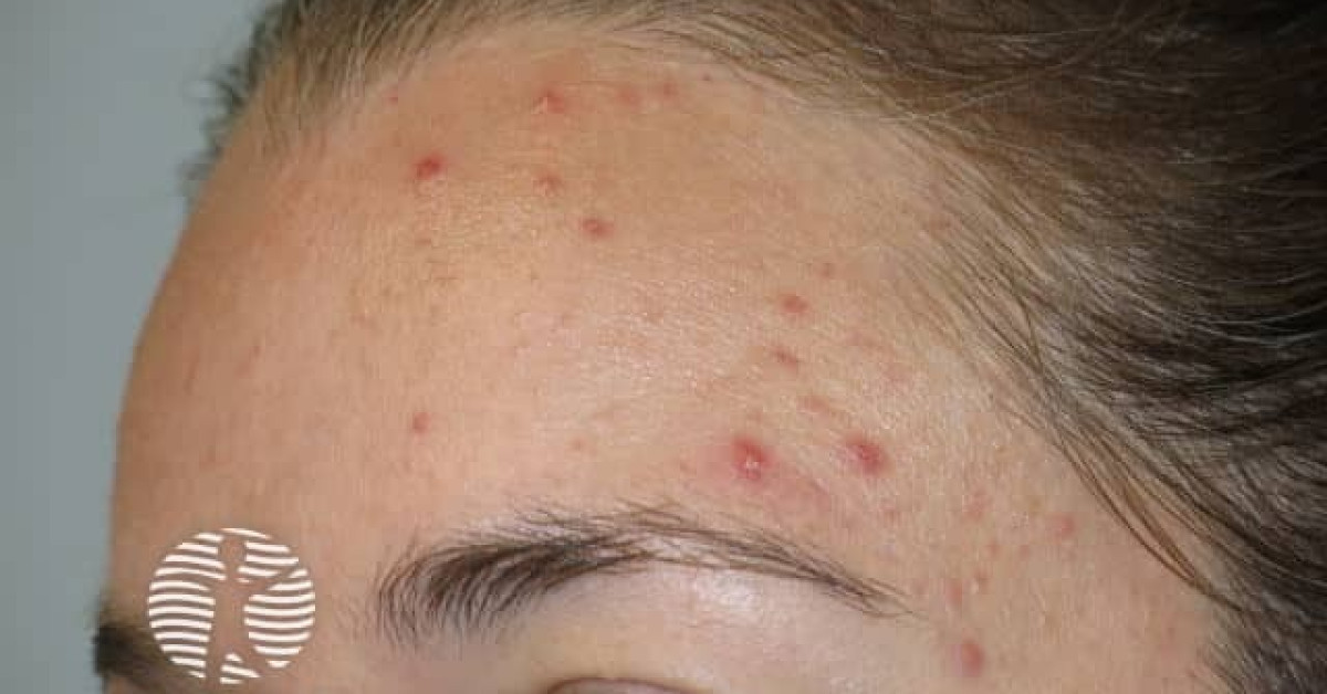 acne-face_3_16 image