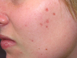 Acne: pink marks