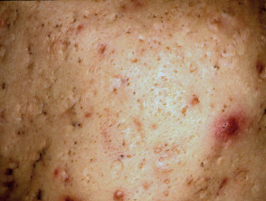Ice-pick acne scars