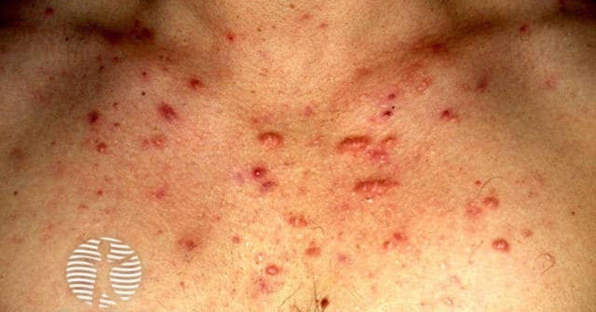 Acne scars image