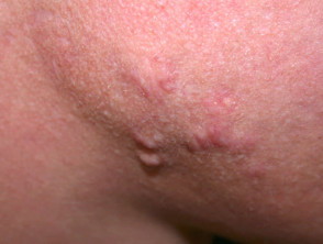 Acne scarring