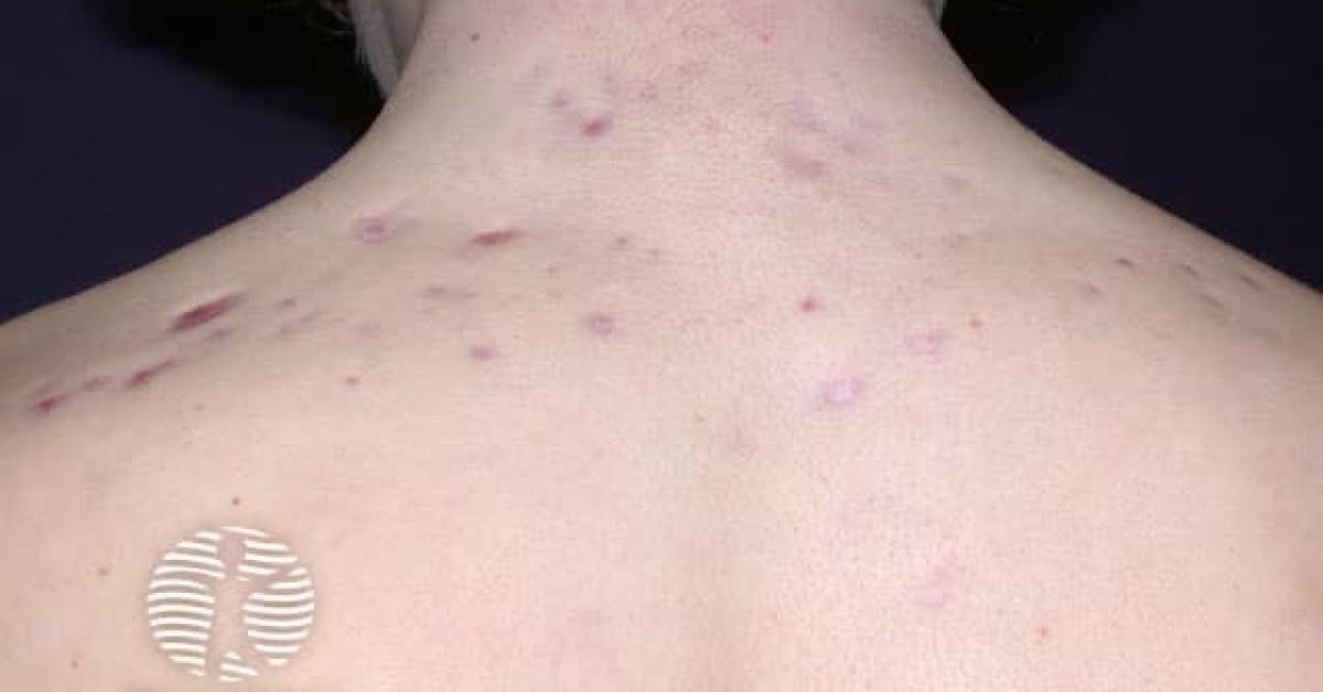 Acne scarring image