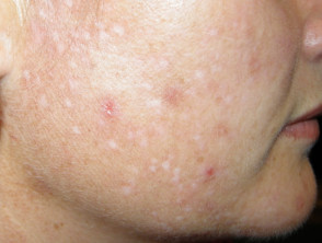 Adult acne