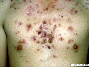 Acne popping severe Causes of