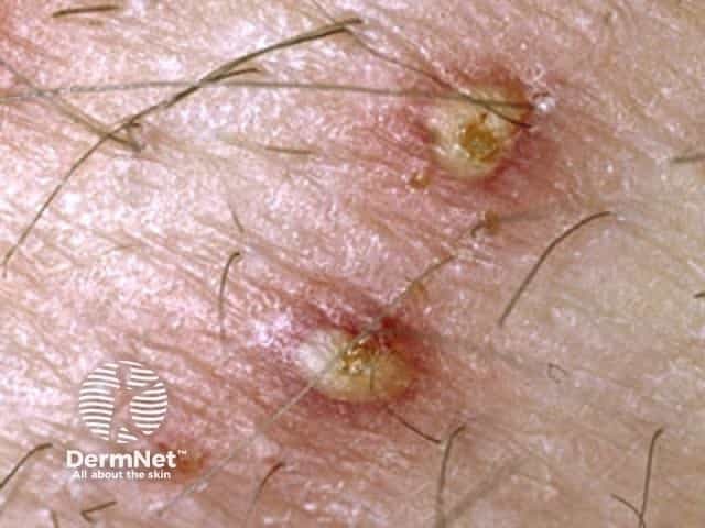 Folliculitis Testicles