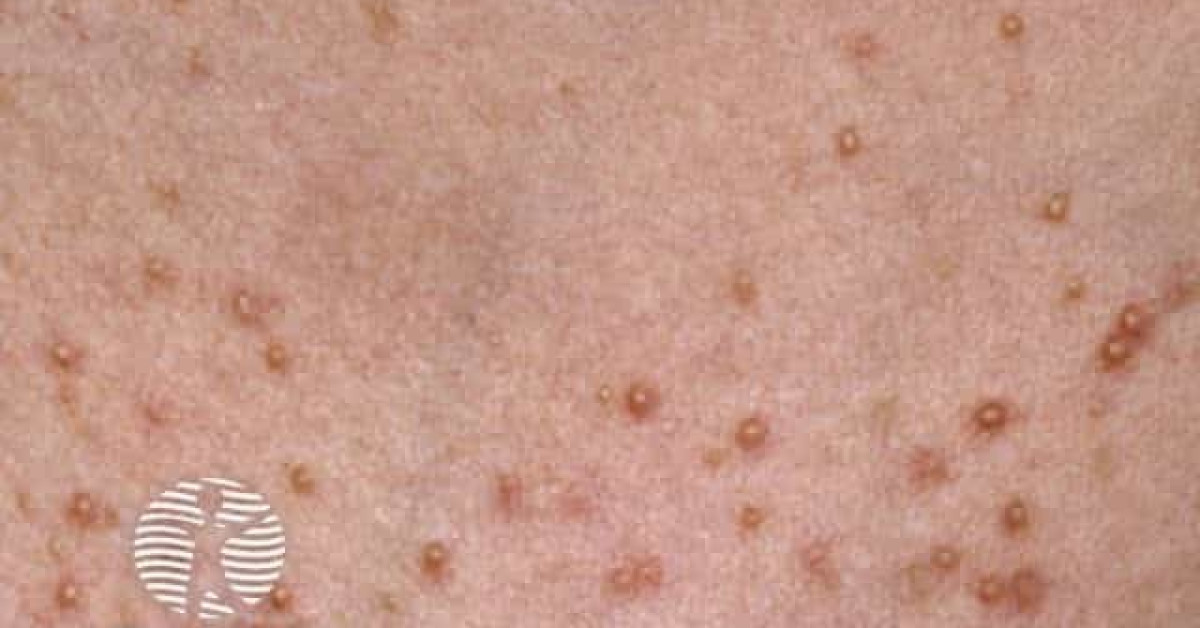 Folliculitis image