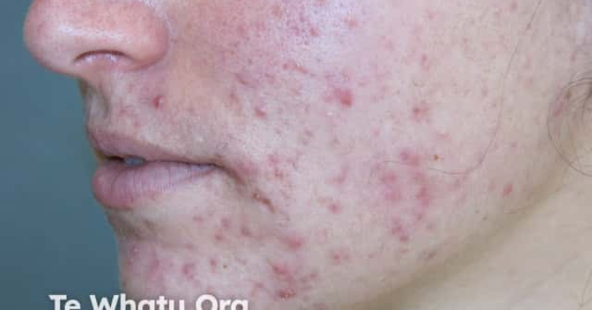 Acne image