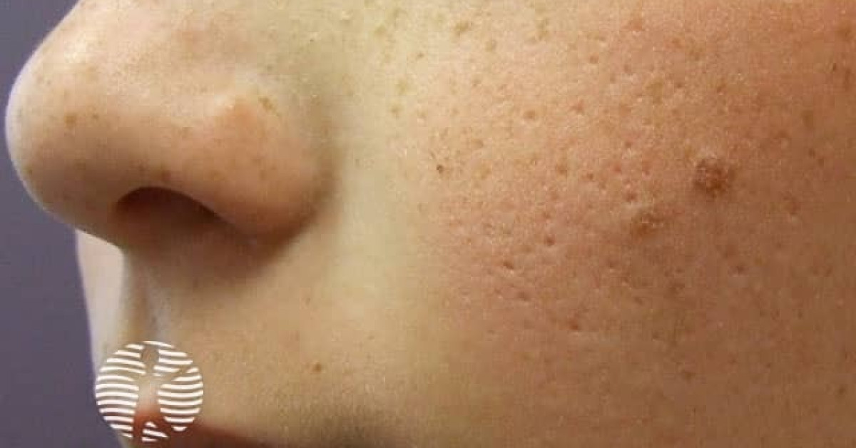 Scarring from infantile acne image