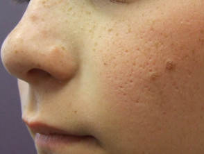 Scarring from infantile acne