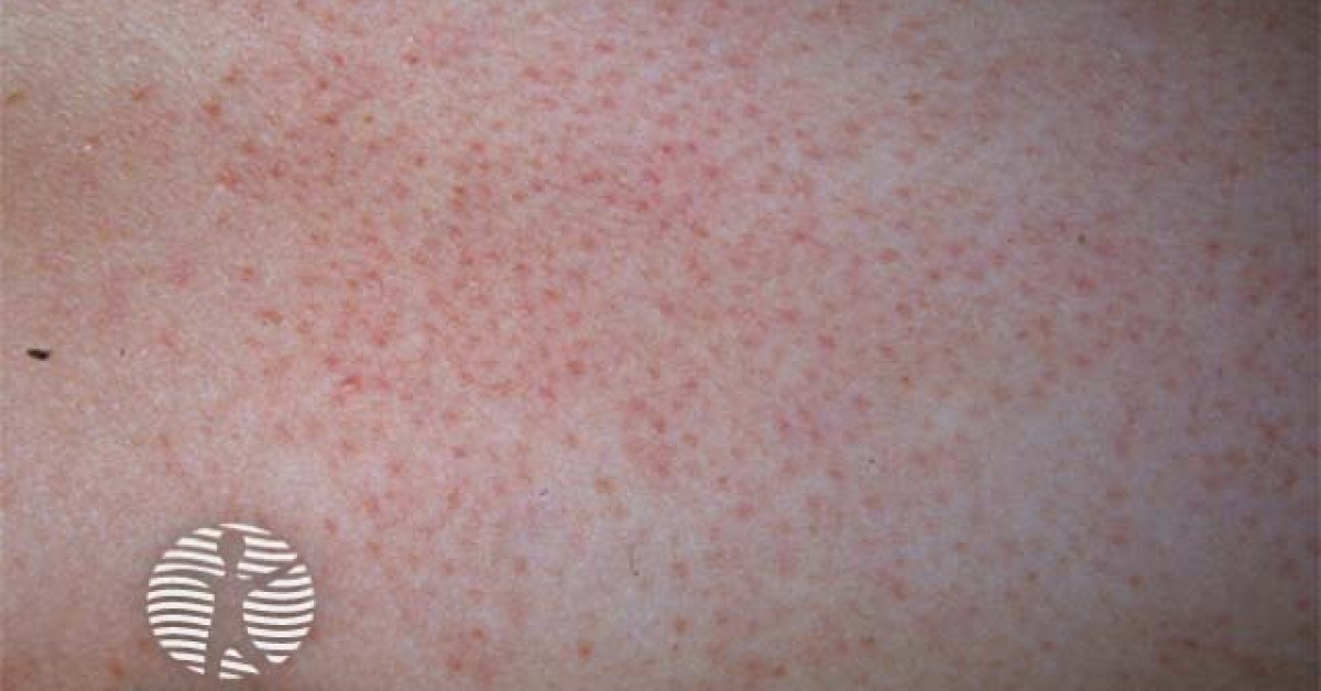 Kp Rash Keratosis pilaris image