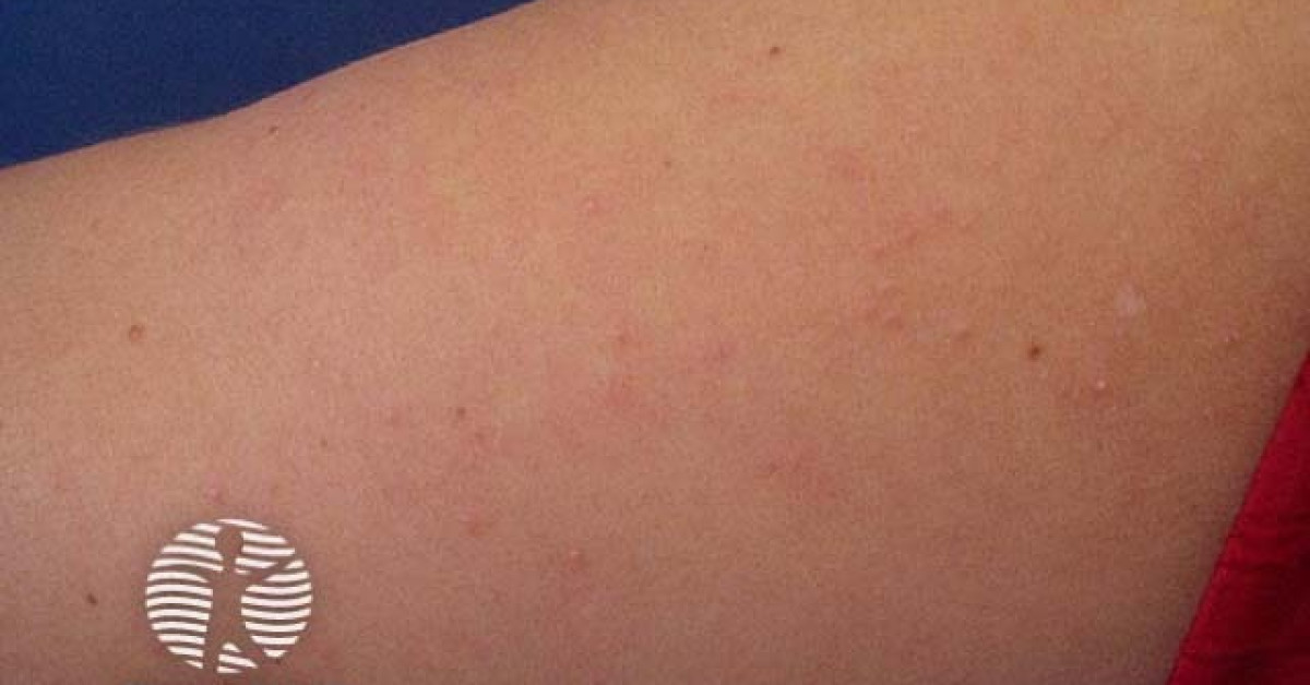 Piliaris Rash Keratosis pilaris image