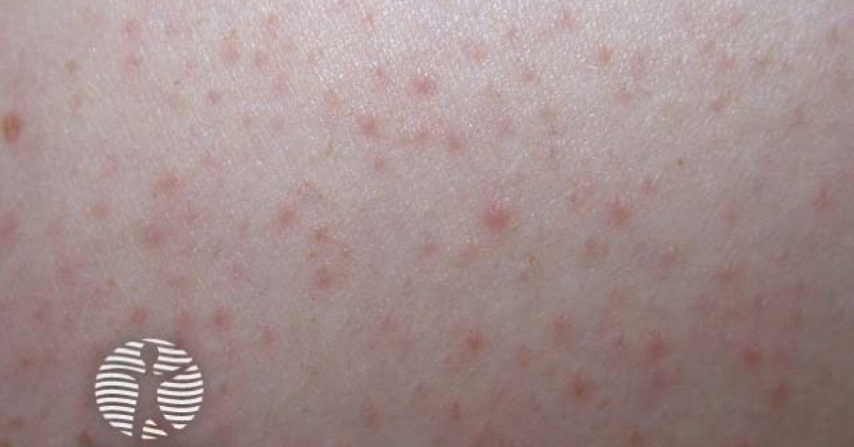 Kp Rash Keratosis pilaris image