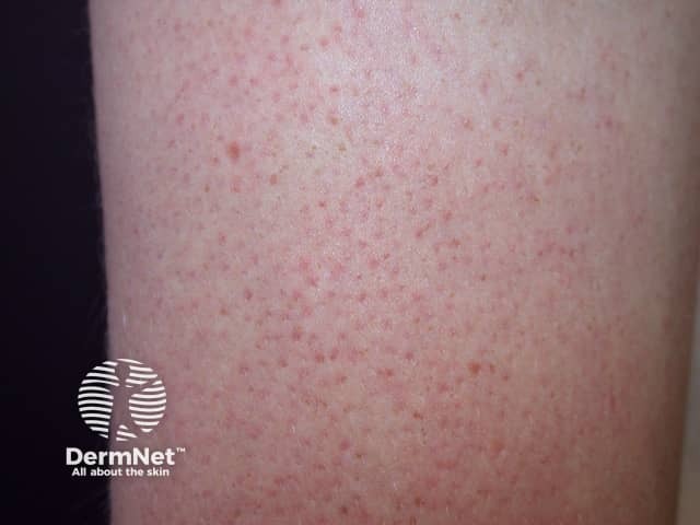 Atopic dermatitis: keratosis pilaris