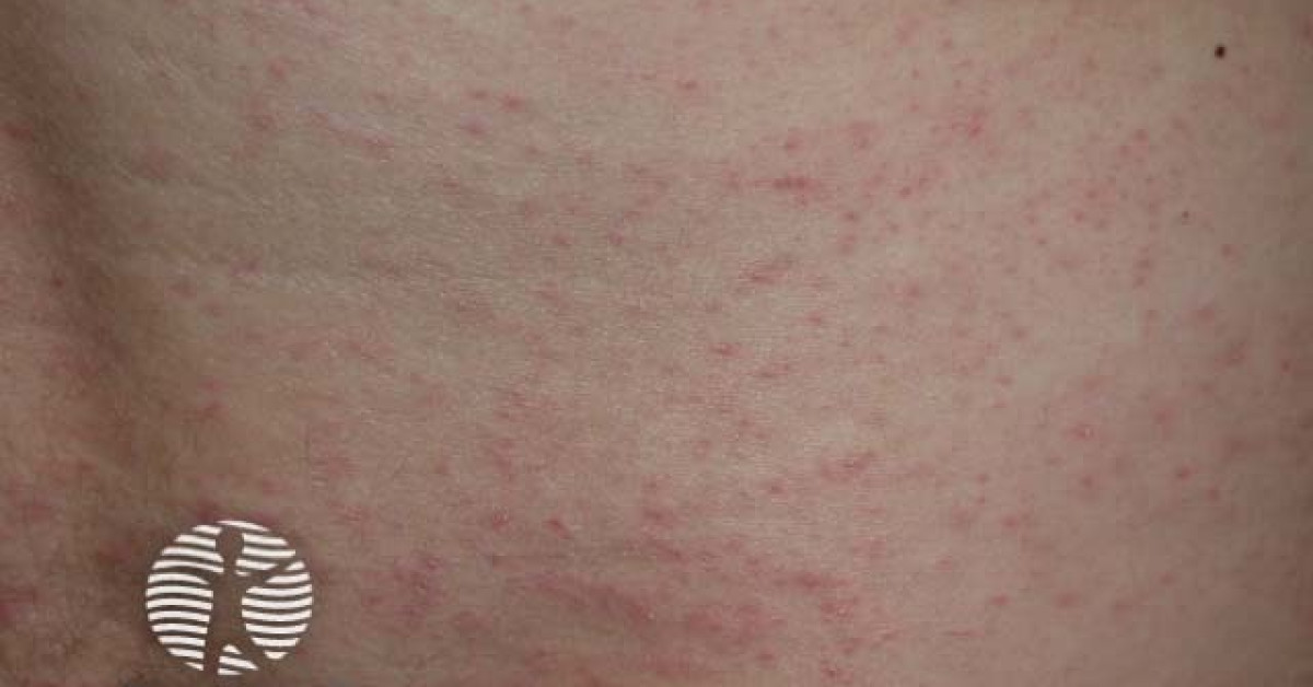 Kp Rash Keratosis pilaris image