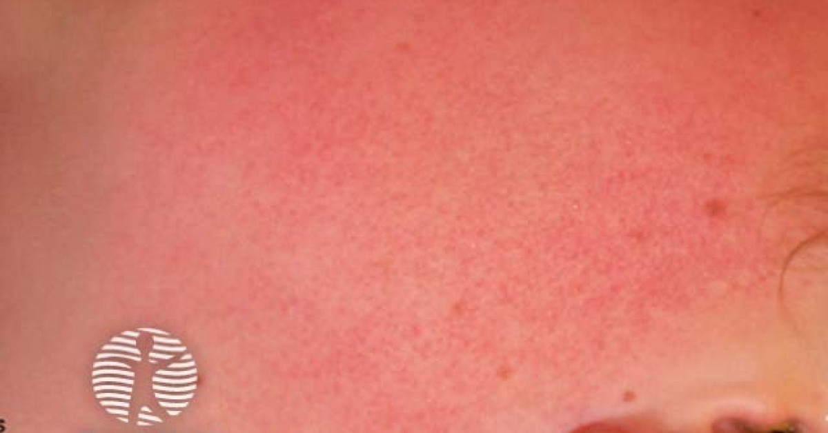 Piliaris Rash Keratosis Pilaris Face Dermnet