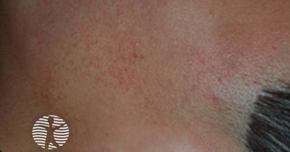 Piliaris Rash Keratosis pilaris image