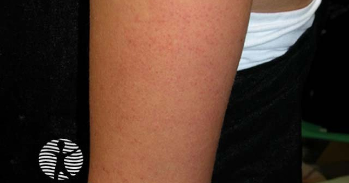 Kp Rash Keratosis pilaris image