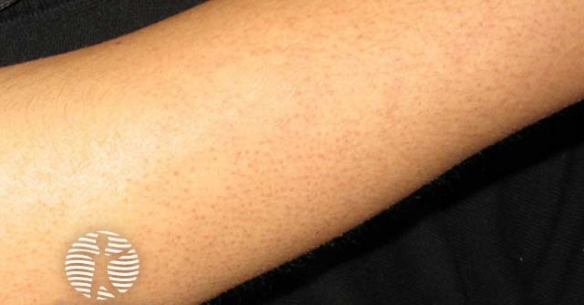 Piliaris Rash Keratosis pilaris image