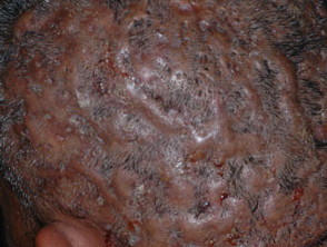 Perifolliculitis capitis abscedens et suffodiens