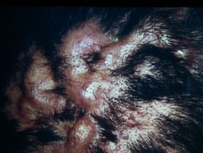 Dissecting cellulitis