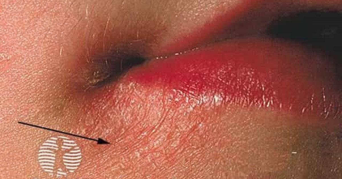 perioral-dermatitis-image