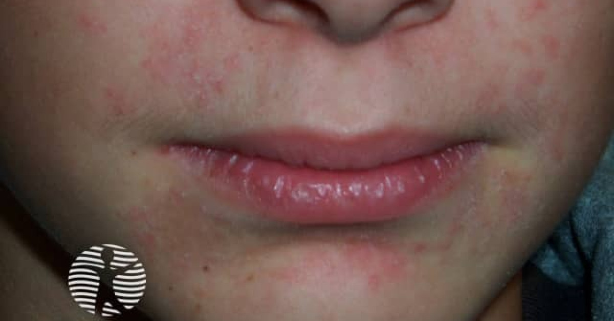 Perioral dermatitis image