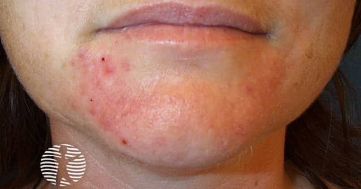 perioral-dermatitis-image