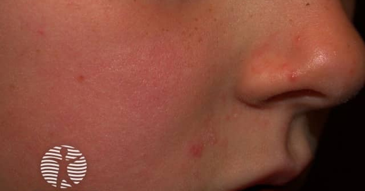 perioral-dermatitis-image