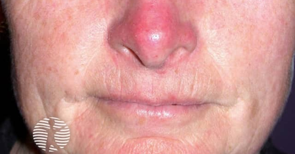 Dermnet rosacea image